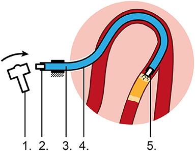 Crossing Total Occlusions Using a Hydraulic Pressure Wave: Development of the Wave Catheter